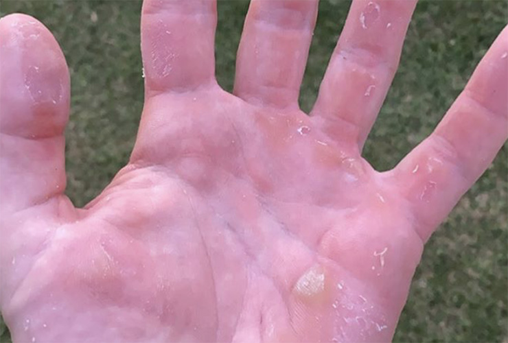 Viktor Hovland’s hand looks like he stuck it in a sausage grinder filled with bees
