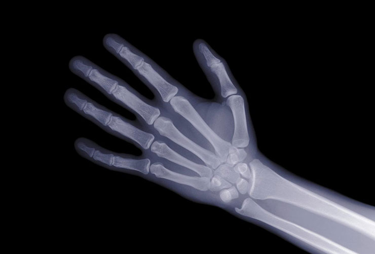 Love hitting balls on the range? Watch out for this common golf injury